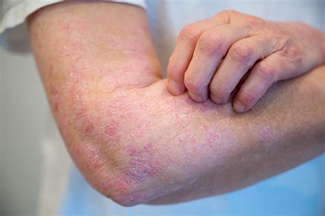 Understanding eczema: definition, symptoms, causes, and treatments