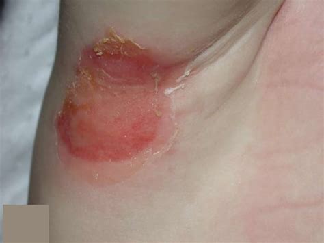 I Have A Rash Under My Left Armpit at Humberto Watts blog