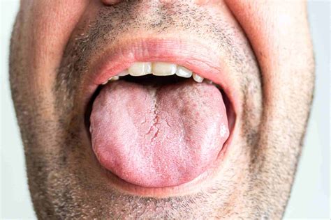 Furrowed Tongue Down Syndrome