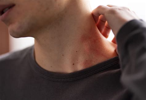 Las ronchas en la piel no siempre son una reacción alérgica: qué es la urticaria crónica ...