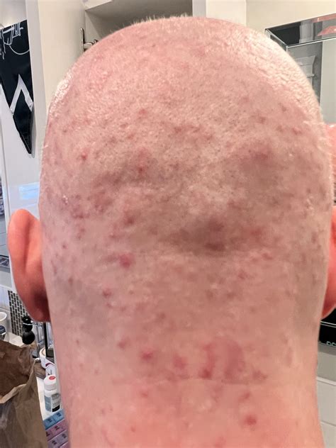 Scalp Acne