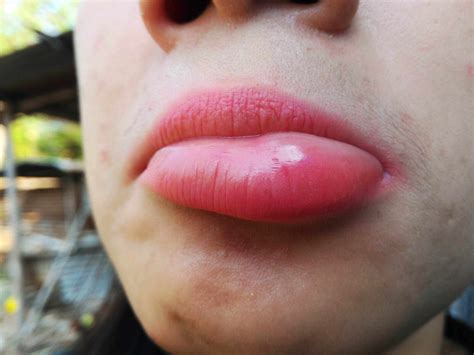 Lips Breaking Out In Blisters at Michael Brehm blog
