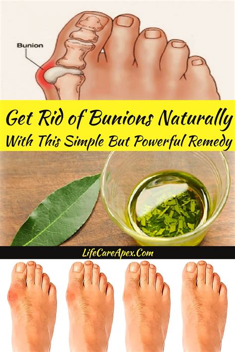 Homemade Bunion Remedy at Fred Grant blog