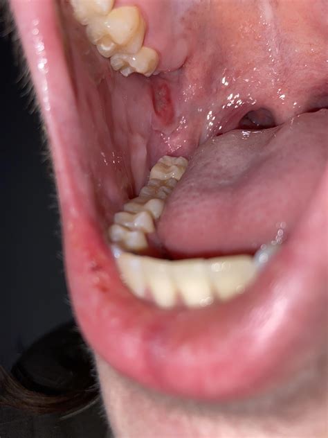 Canker Sores On Gums Around Teeth