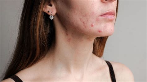 How to successfully treat hormonal cystic acne – Skincare by Sydney