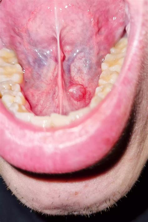 What Causes a Ranula (Cyst Under the Tongue) and How Is It Treated?