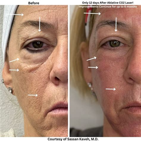 CO2 Laser Resurfacing Around Eyes: The Best Non-Surgical Fix for Fine ...