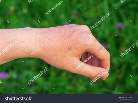 Sun Allergy On Hands