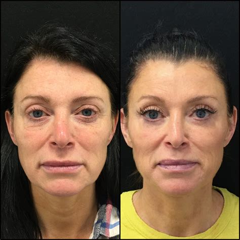 Upper Blepharoplasty Before After
