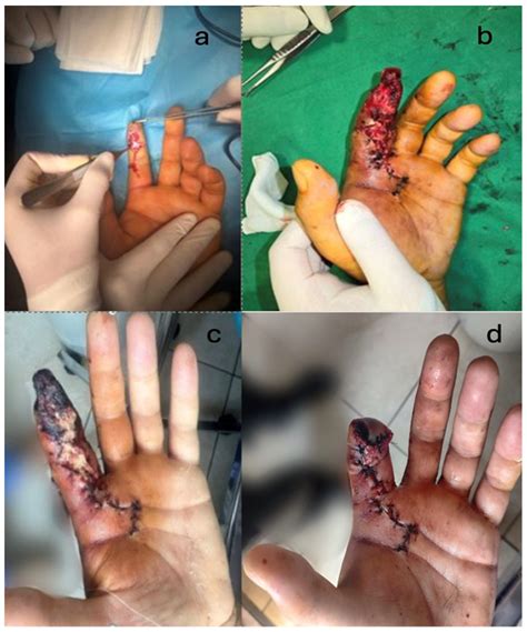 High-Pressure Injection Injury of the Hand—A Rare but True Surgical ...