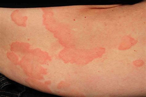 Hives on the Stomach: Causes and Treatments