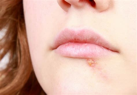 Herpes Lips Treatment