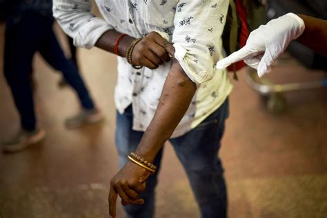 Monkeypox rash and scars: What does monkeypox look like? - ABC News