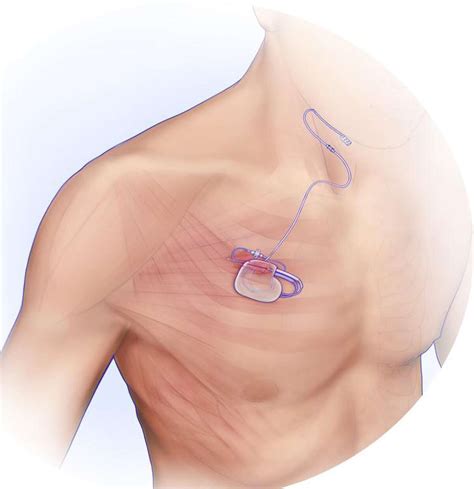 It’s sweet dreams for sleep apnea patient with this implanted device