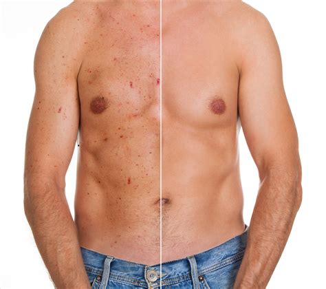 Chest Acne