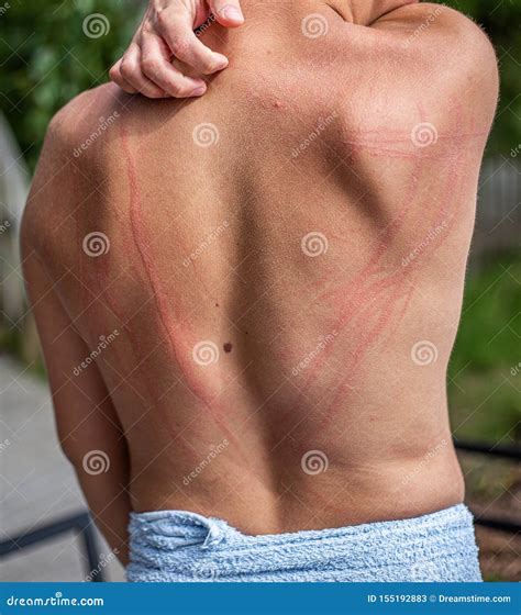 Dermatographic Urticaria Also Known As Dermographism, Dermatographism Or `skin Writing` Royalty ...