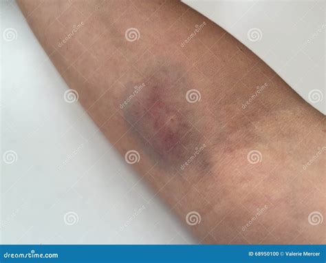 What Is A Bruised Elbow at Sophie Jacqueline blog
