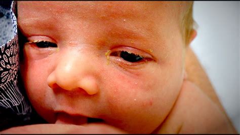 Is It Normal For Newborn Babies To Have Yellow Eyes at Ricardo Fletcher ...