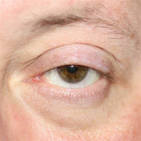 Drooping lower eyelid online