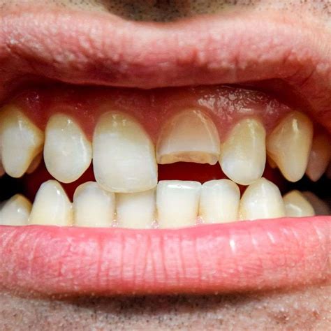 Broken Teeth Repair