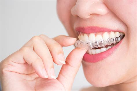 ClearCorrect: An Alternative to Braces — Herbert S. Birnbaum, DMD