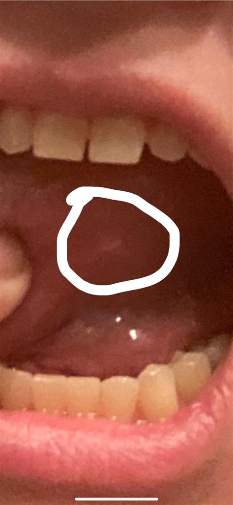Painful white lump on underside/side of tongue : r/askdentists