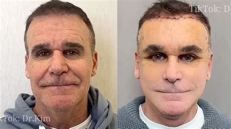 Who's Dr. Kim The Plastic Surgeon On TikTok? The Viral Facelift Doctor ...