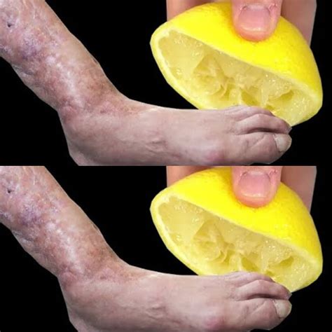 Mom’s Natural Remedy with Lemon: A Cure-All for Leg Pain, Rheumatism, Varicose Veins, Arthritis ...