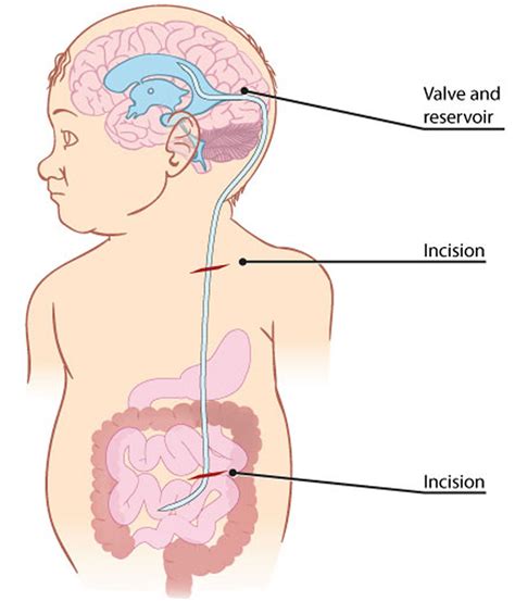 Hydrocephalus - Causes, Symptoms In Babies & Adults, Treatment
