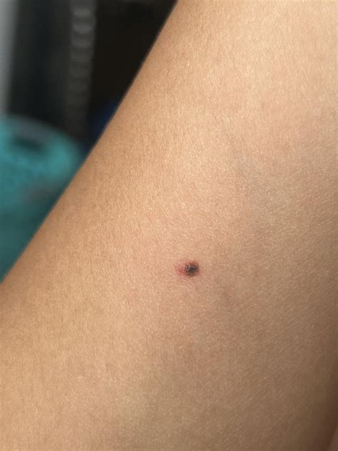 Melanoma or bruise/scratch : r/DermatologyQuestions