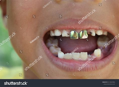 Silver Canine Tooth Cap