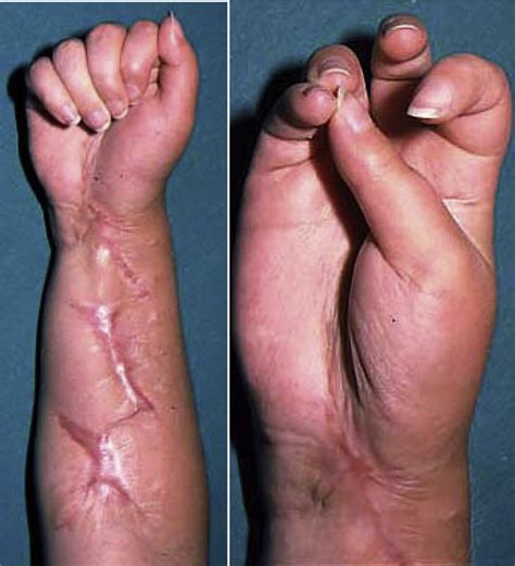 Volkmanns Contracture Results Of Neurolysis In Established Upper Limb