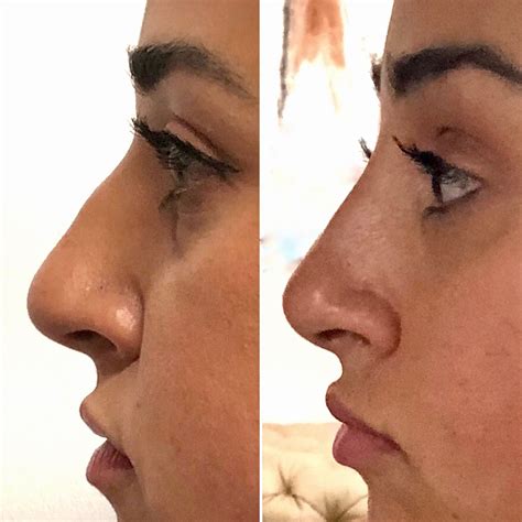 Non surgical rhinoplasty and nose jobs – Artofit