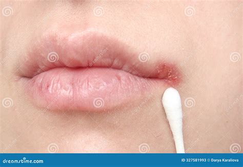 Herpes in the Corner of the Lips Stock Image - Image of dermatitis ...