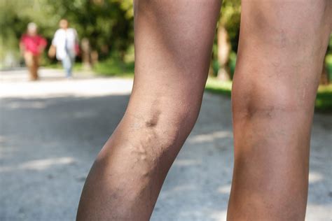 Preventing Ruptures and Serious Complications from Varicose Veins