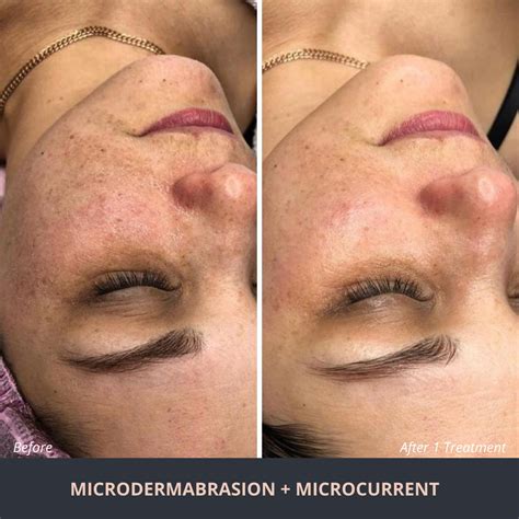Microdermabrasion - Novuskin