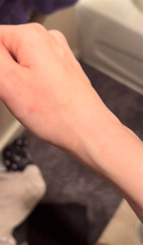 Painful bulging wrist vein : r/carpaltunnel