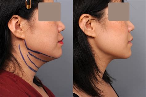 Chin And Neck Lipo Recovery at Amparo Lisi blog