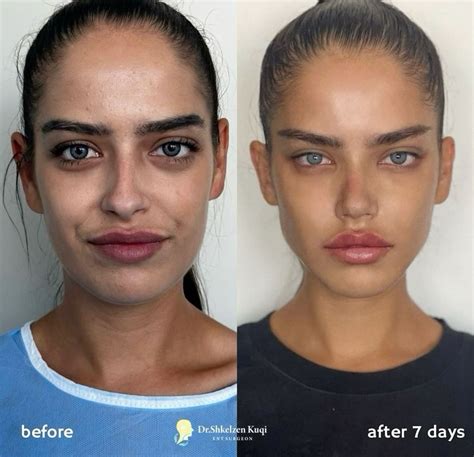 Nose job in 2025 | Rhinoplasty nose jobs, Plastic surgery, Nose job