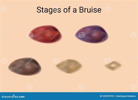 Healing Stages of Bruises and Hematomas Stock Vector - Illustration of ...