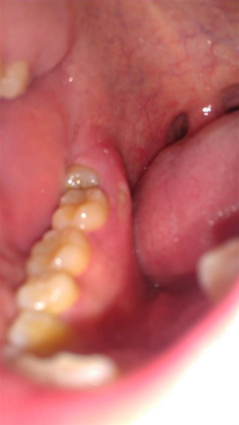 Red Spots On Gums With Braces at Daniel Mcbryde blog