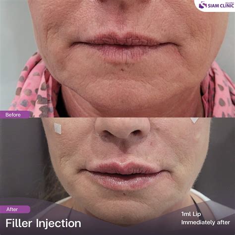 Lip Fillers Before and After Photos - Siam Clinic Thailand