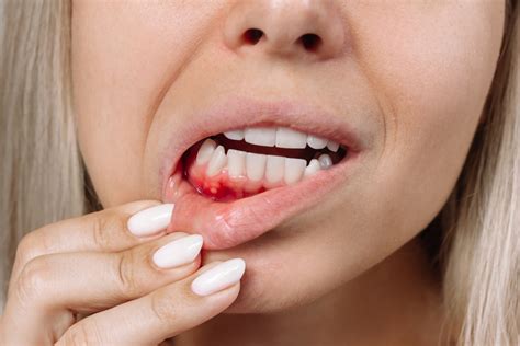 Pinhole Gum Surgery Cost: Key Factors to Consider