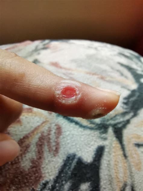 Band Aid Wart Remover at Callum Ardill blog