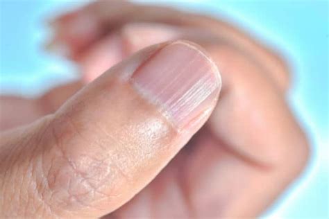 Vertical Lines on Fingernails | How To Achieve Healthy Nails