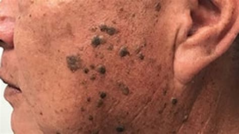 New Options for the Treatment of Extensive Seborrheic Keratosis