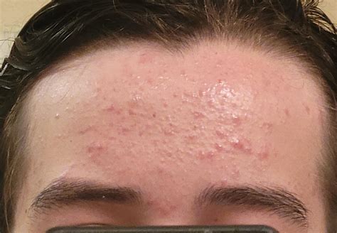Fungal acne? I have been using Nizoral and it's only gotten slightly worse. : r/Fungalacne
