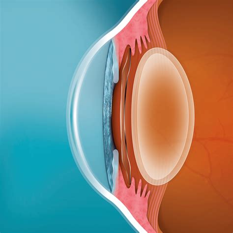 EVO ICL Eye Surgery | EVO Implantable Collamer Lens