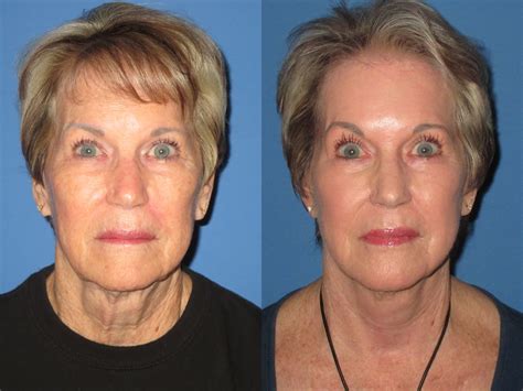 Facelift Photos Before After Dr James Pearson Facial Plastic Surgery | My XXX Hot Girl