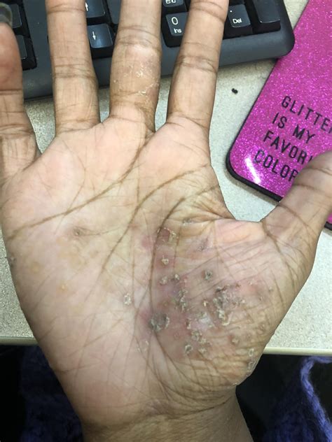 I get water blisters on my hands from eczema and then they burst and I get the flakes. Does this ...